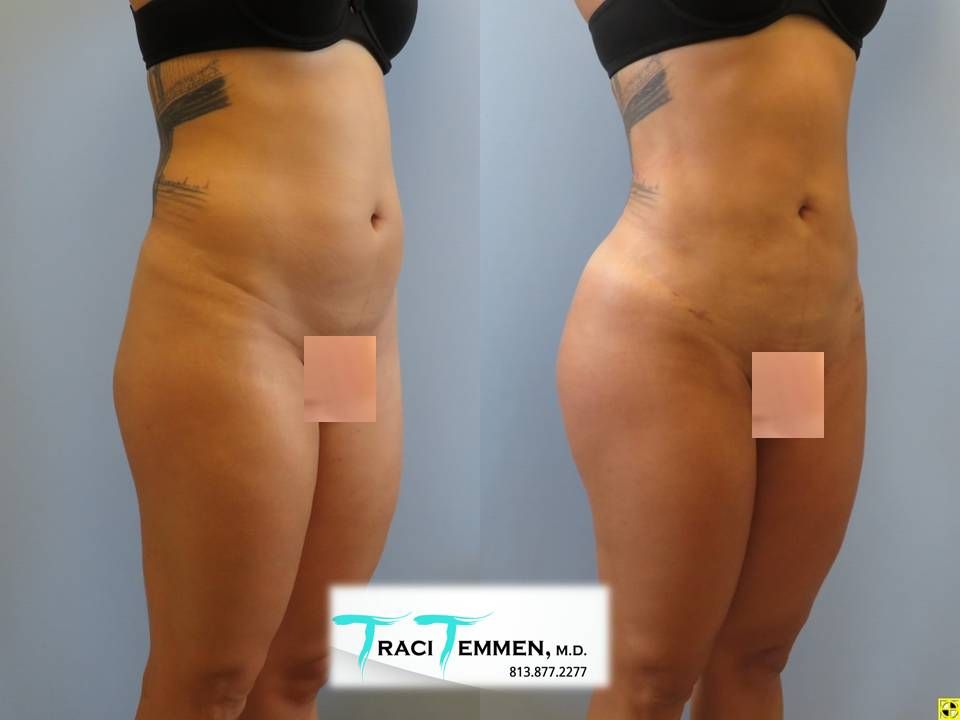 Liposuction Before & After