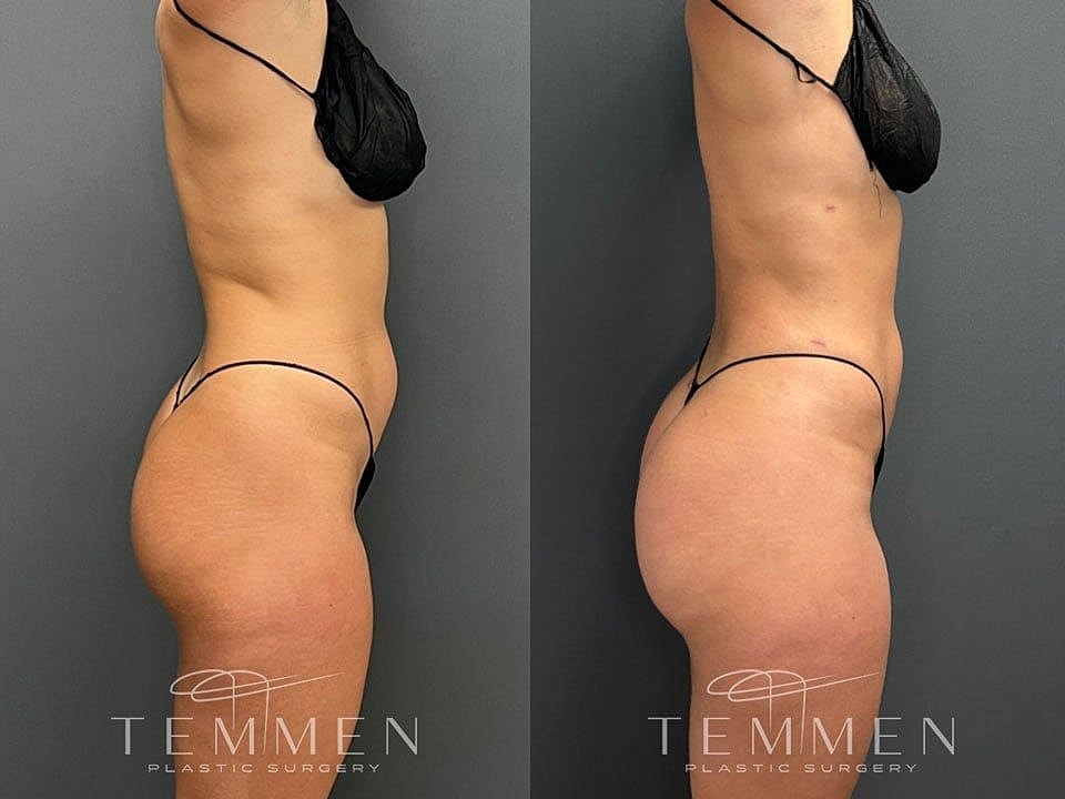 Liposuction Before & After