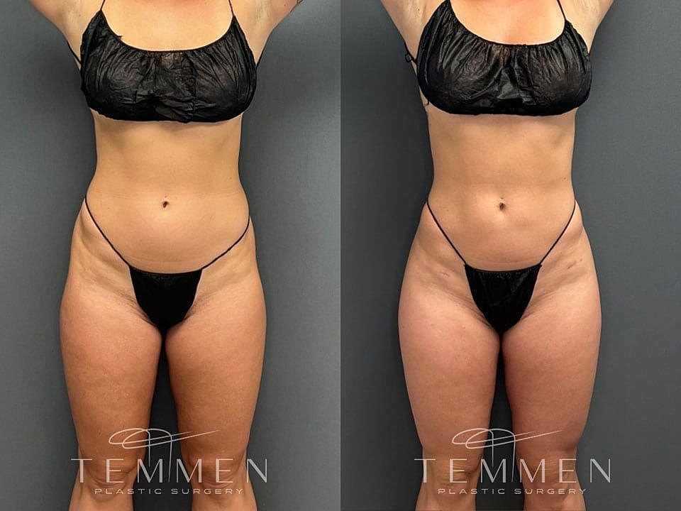 Liposuction Before & After