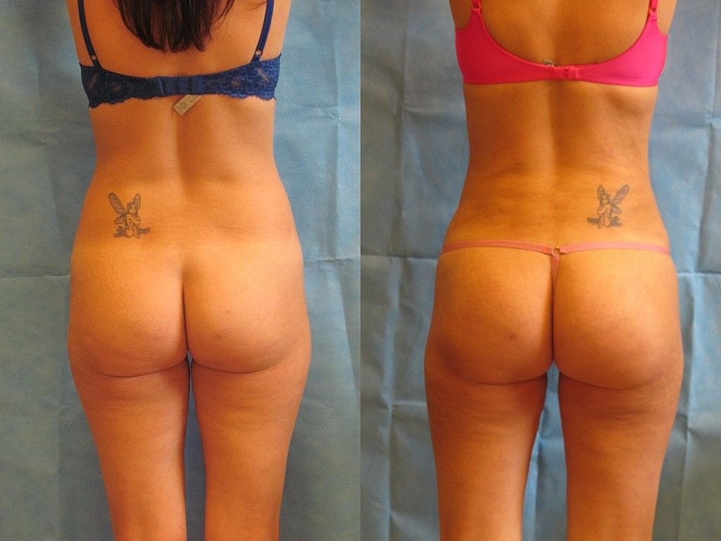Liposuction Before & After