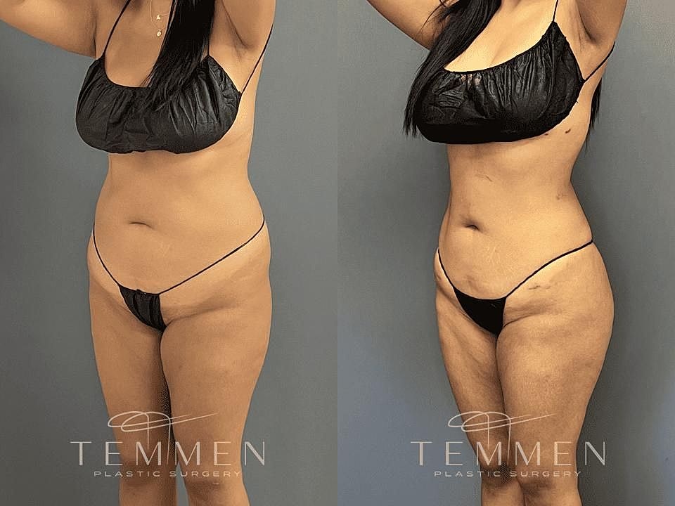 Liposuction Before & After