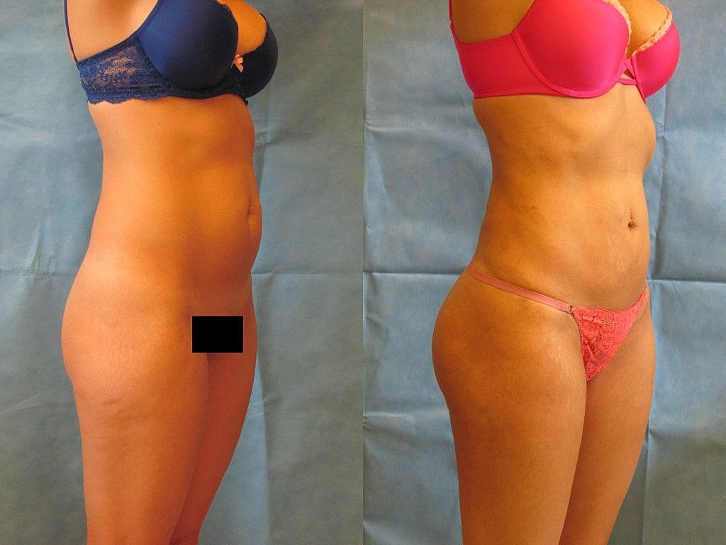 Liposuction Before & After