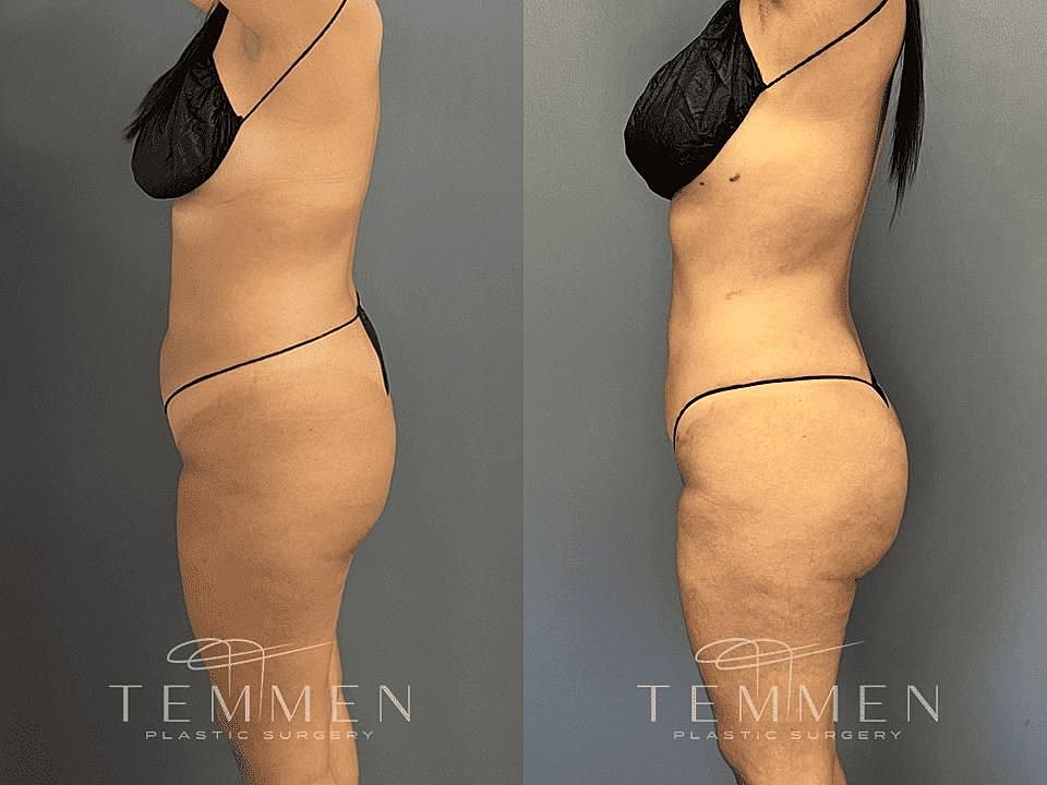 Liposuction Before & After