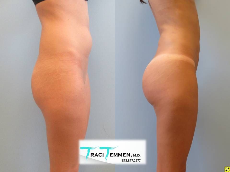 Liposuction Before & After