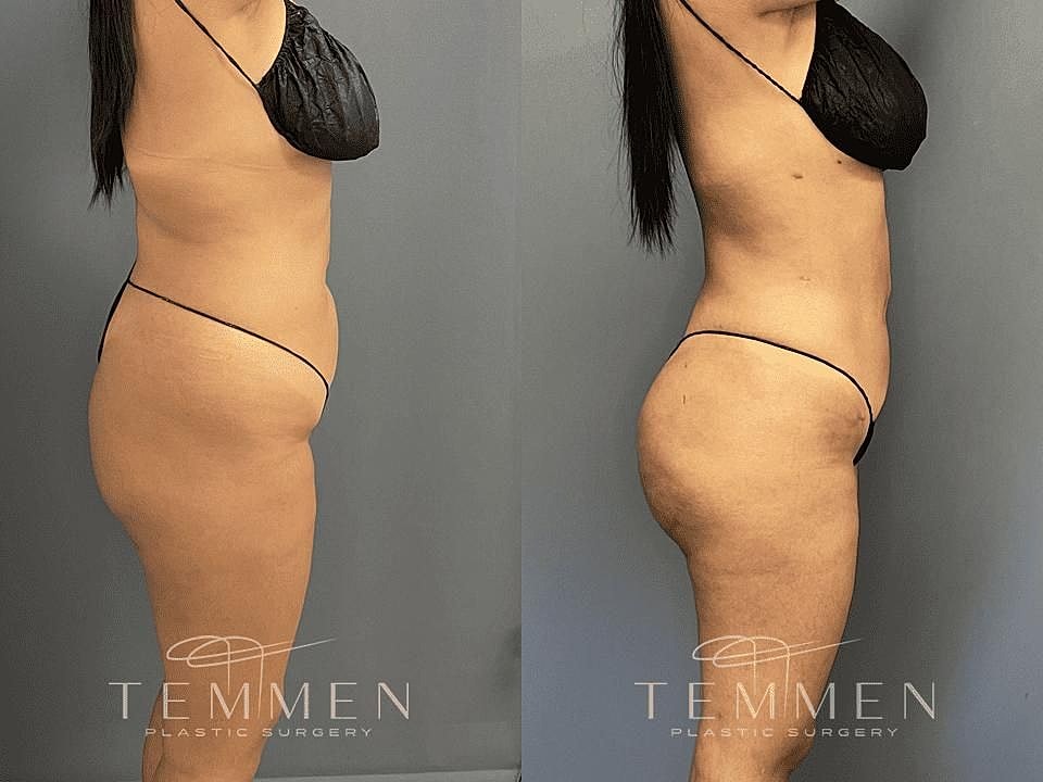 Liposuction Before & After
