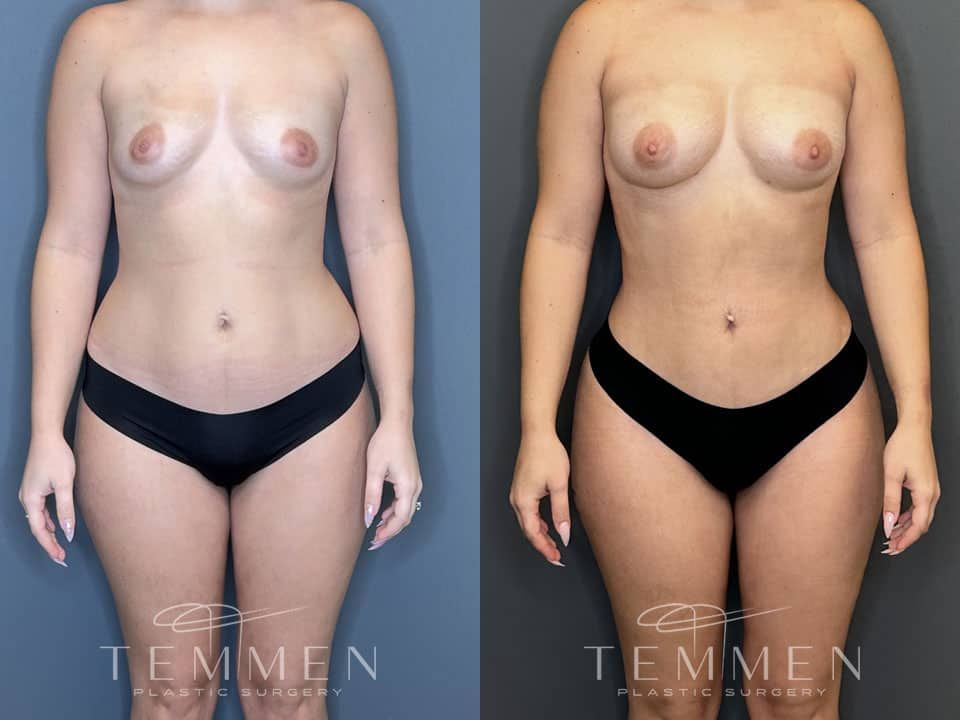 Liposuction Before & After