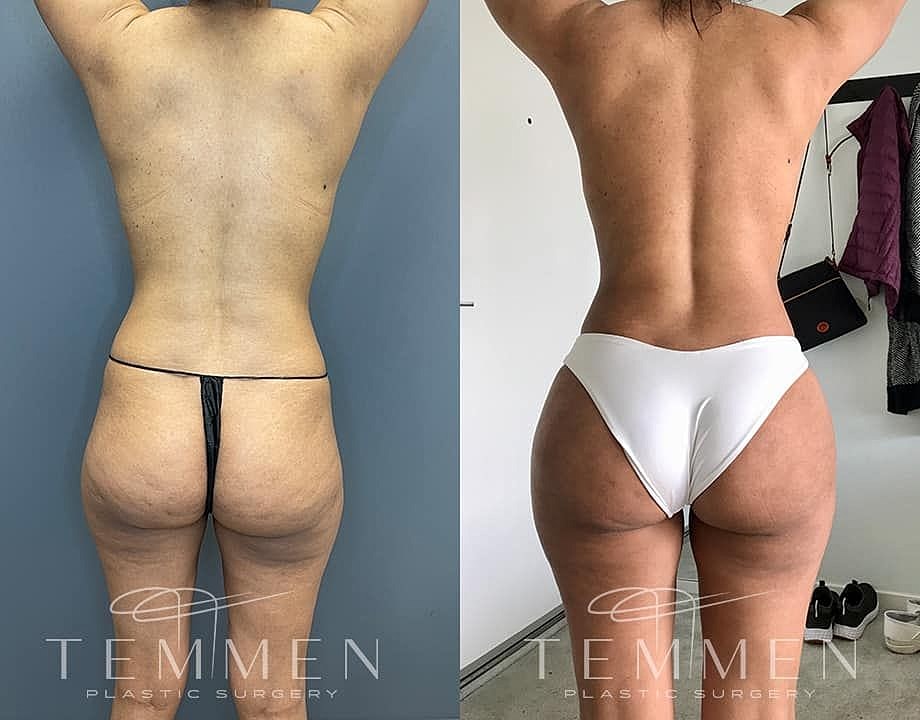 Liposuction Before & After