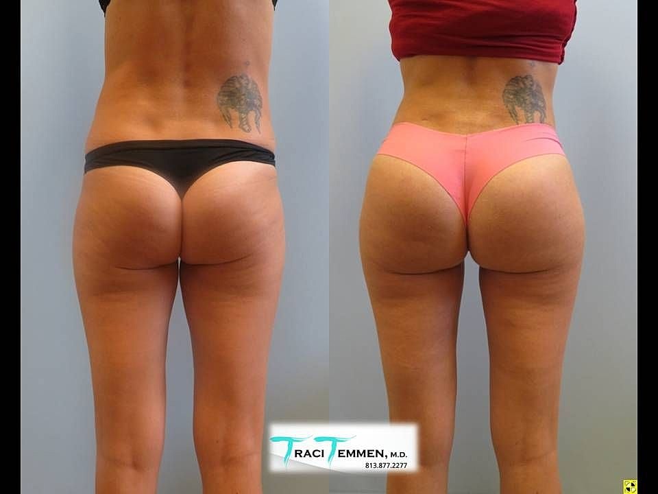 Liposuction Before & After