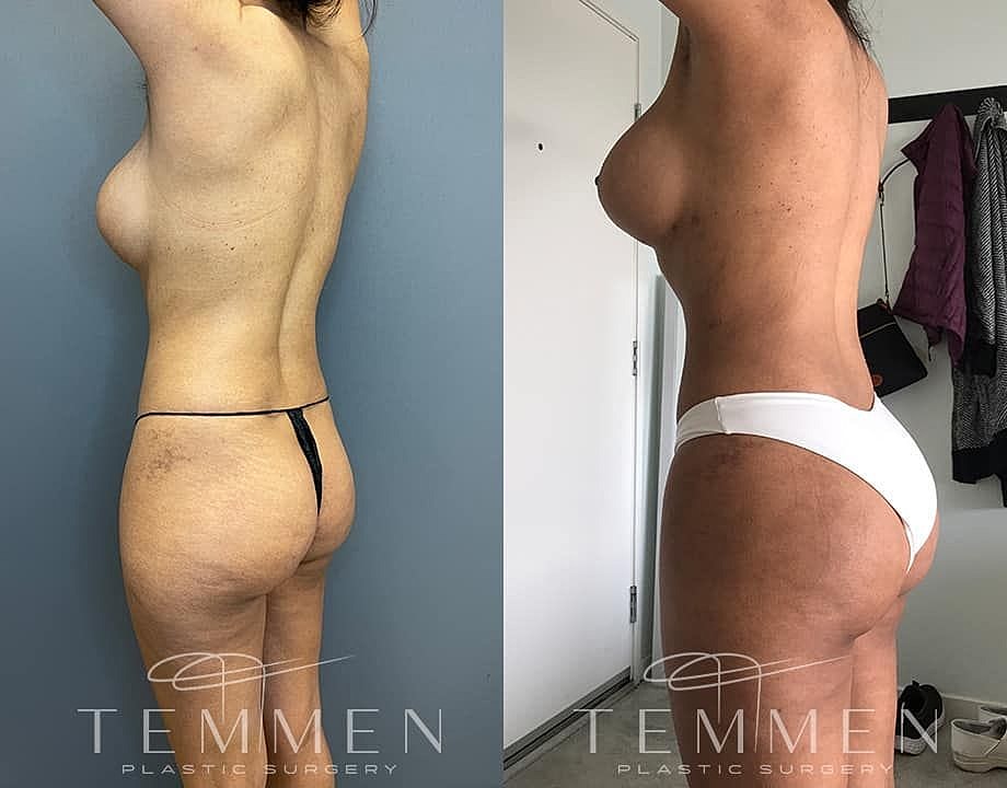 Liposuction Before & After