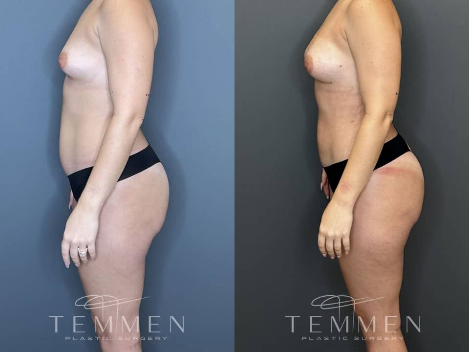 Liposuction Before & After