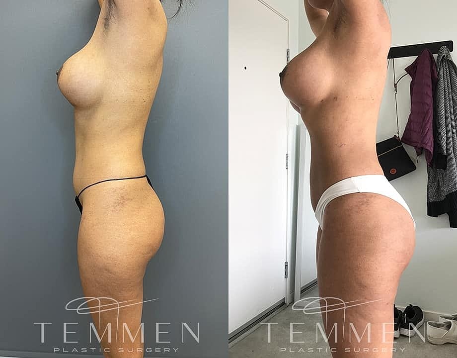 Liposuction Before & After