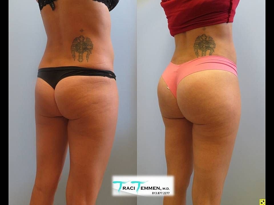 Liposuction Before & After