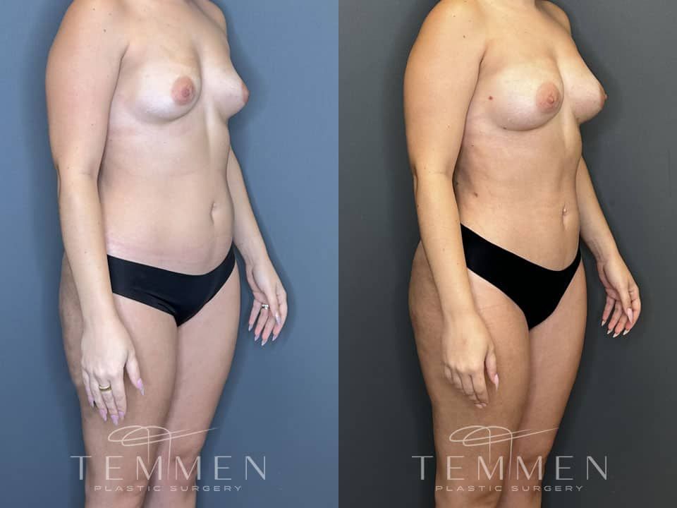 Liposuction Before & After