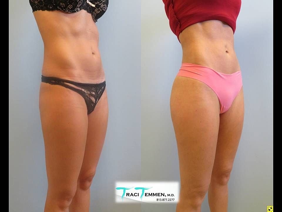 Liposuction Before & After