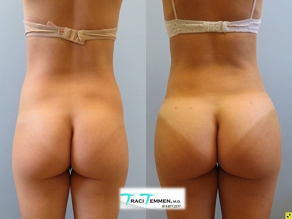 Liposuction Before & After