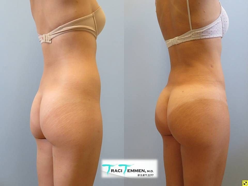 Liposuction Before & After