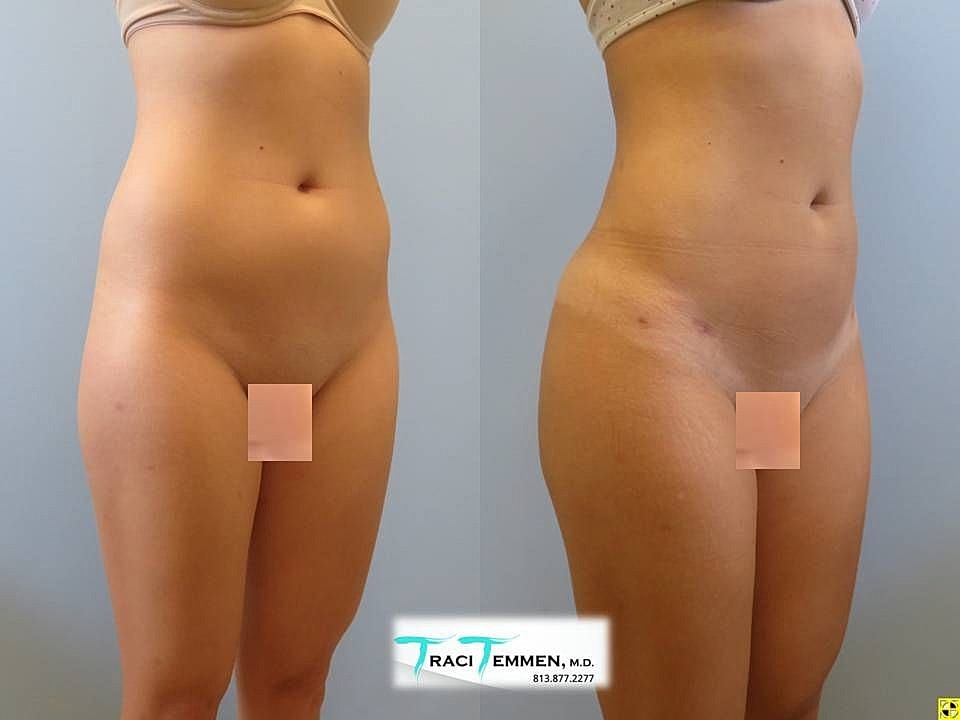 Liposuction Before & After