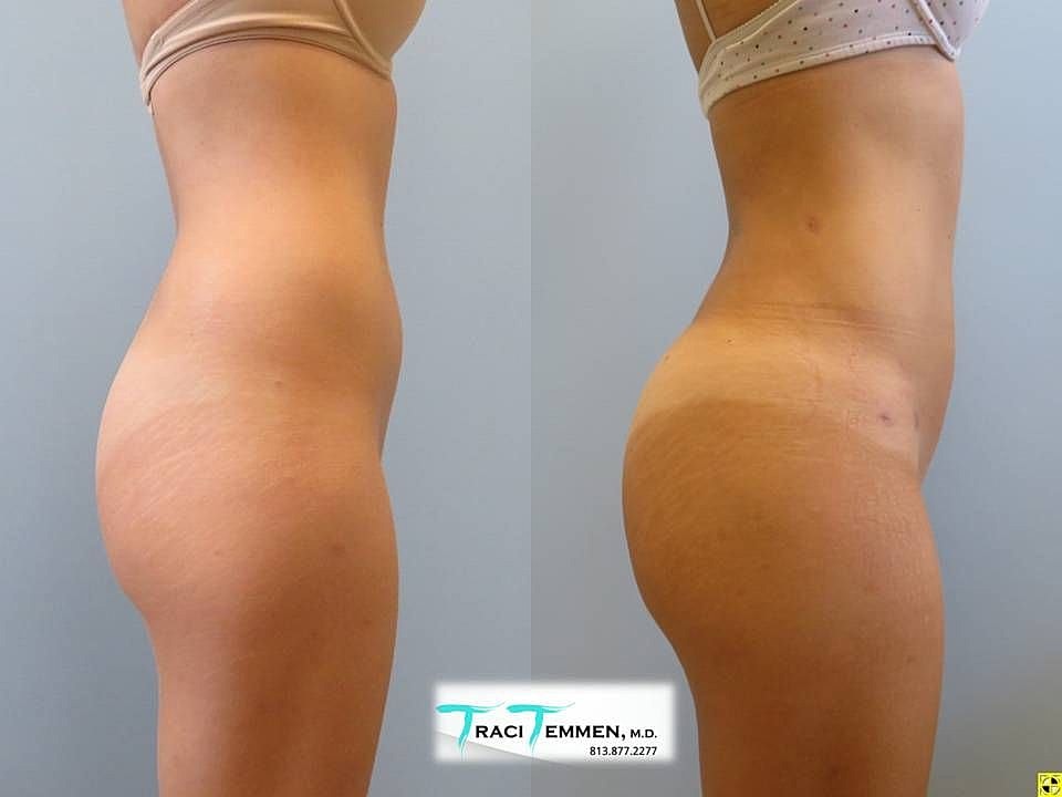 Liposuction Before & After