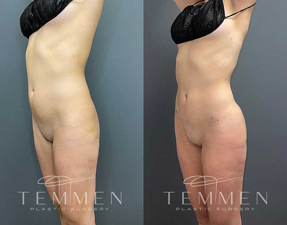 Liposuction Before & After