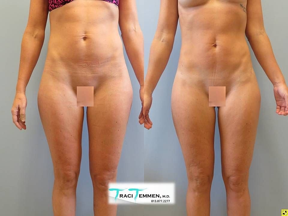 Liposuction Before & After