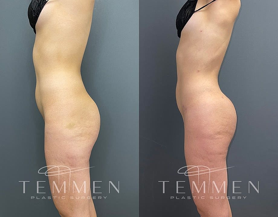 Liposuction Before & After