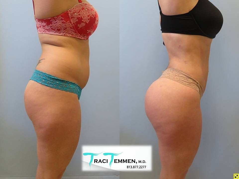Liposuction Before & After