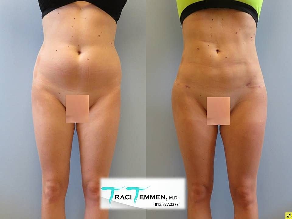 Liposuction Before & After
