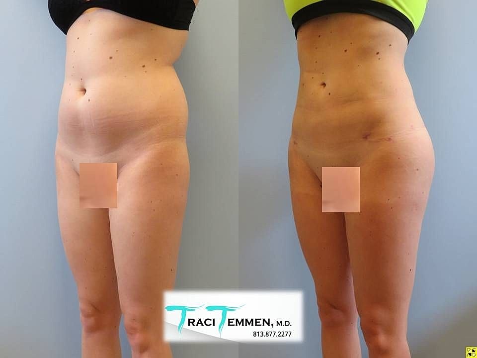 Liposuction Before & After