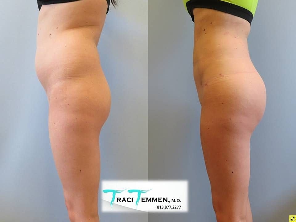 Liposuction Before & After