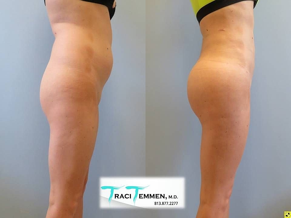Liposuction Before & After