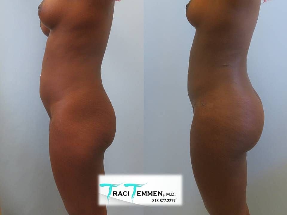 Liposuction Before & After