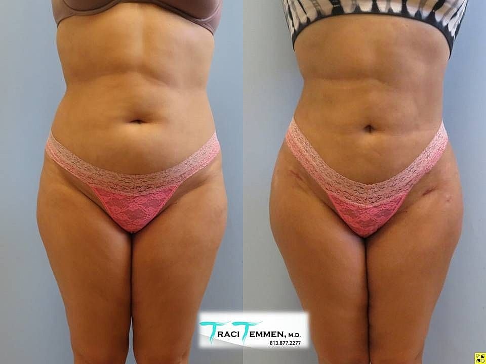 Liposuction Before & After