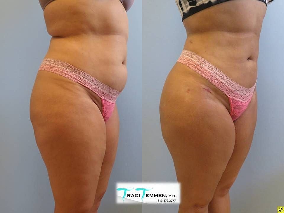Liposuction Before & After
