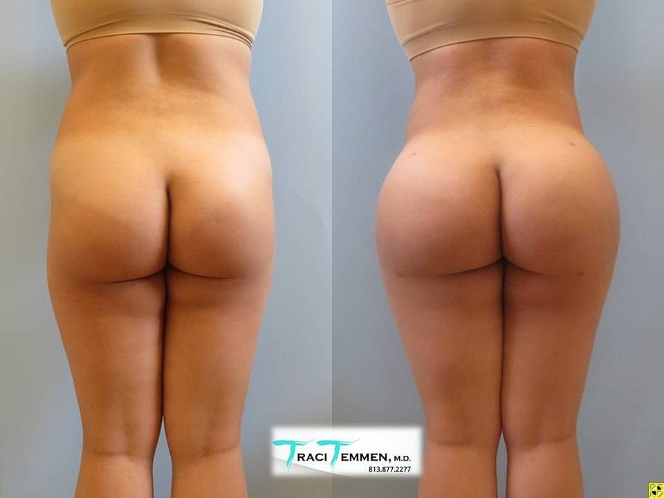 Liposuction Before & After