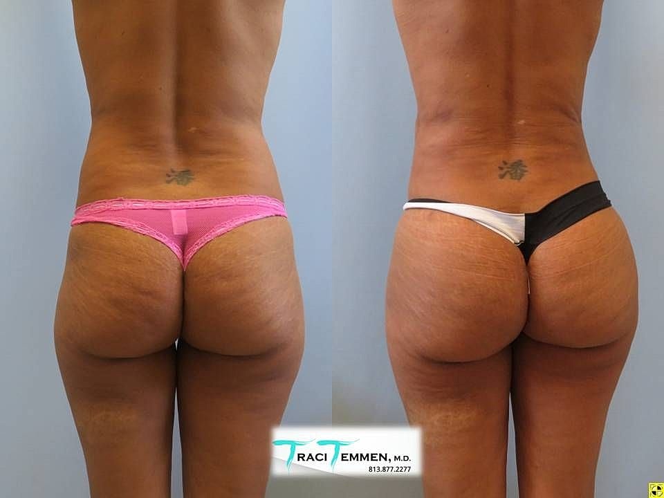 Liposuction Before & After