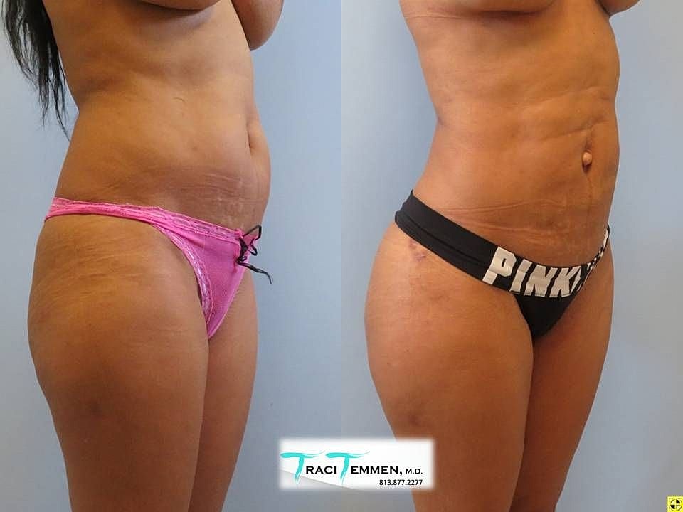 Liposuction Before & After