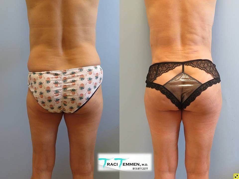 Liposuction Before & After