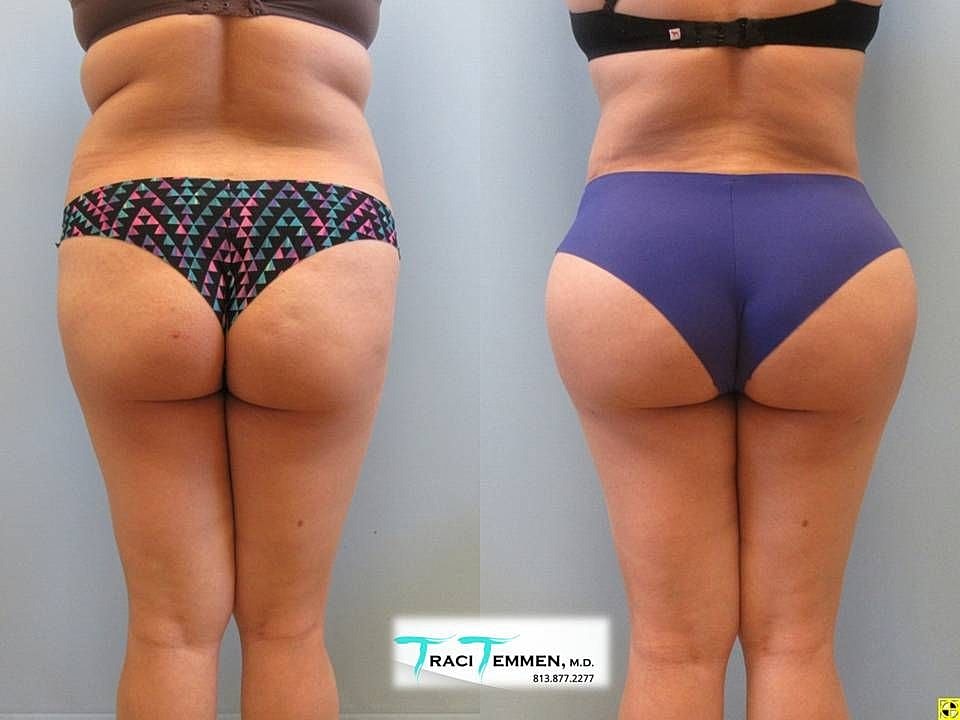 Liposuction Before & After
