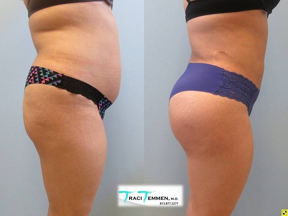 Liposuction Before & After