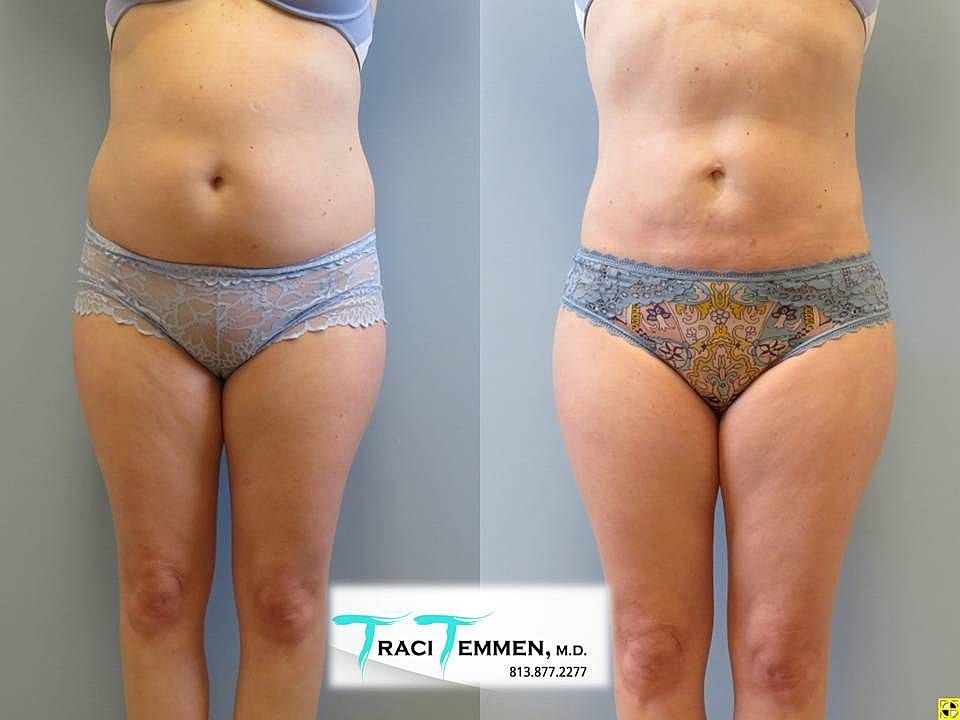 Liposuction Before & After