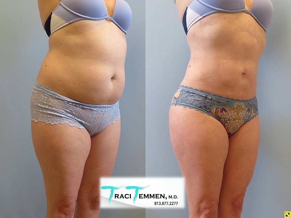 Liposuction Before & After