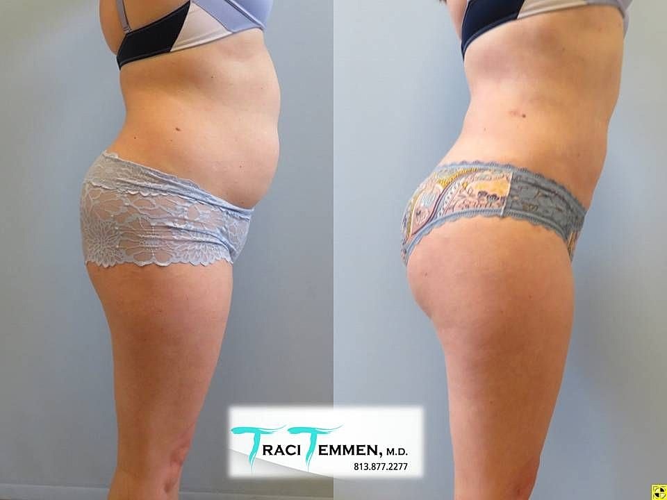 Liposuction Before & After