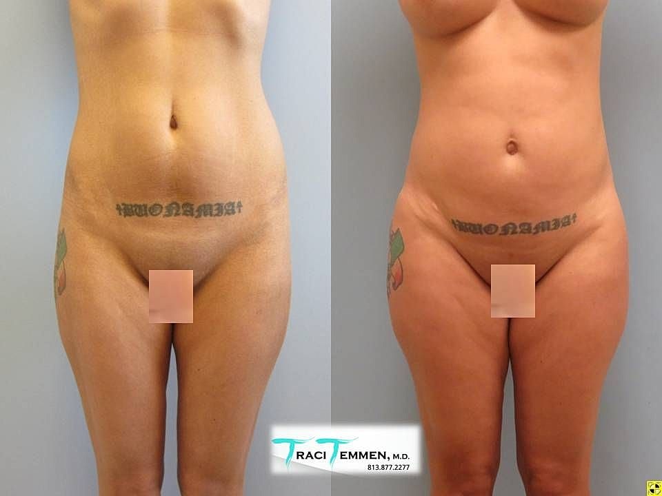 Liposuction Before & After