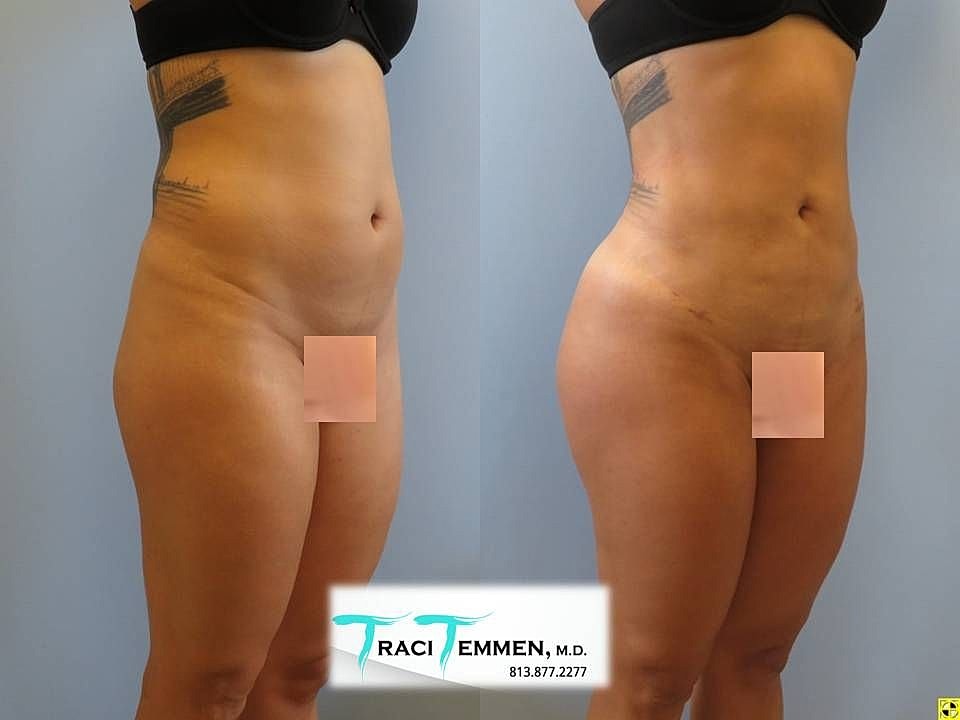 Liposuction Before & After