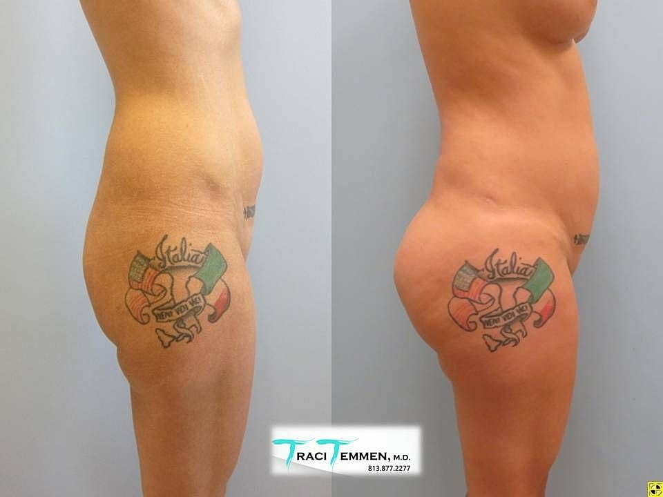 Liposuction Before & After