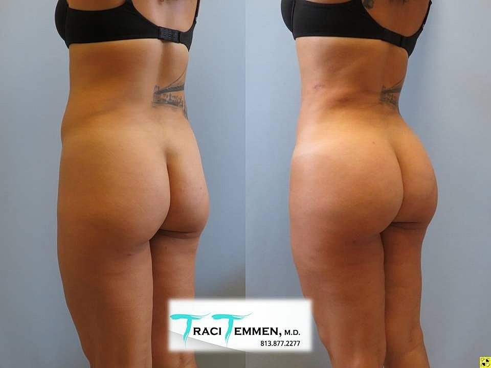Liposuction Before & After