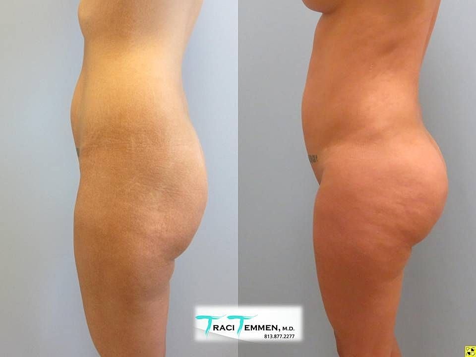 Liposuction Before & After