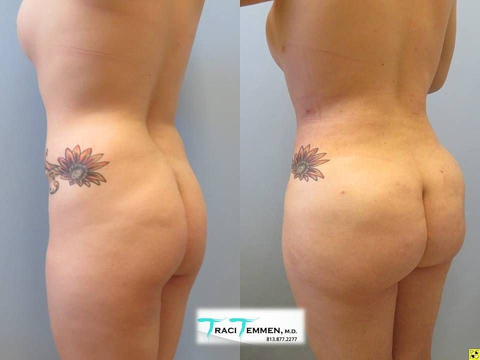 Liposuction Before & After