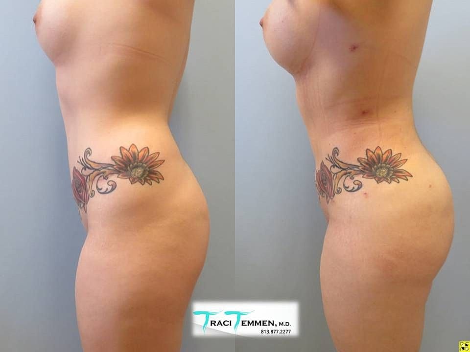 Liposuction Before & After