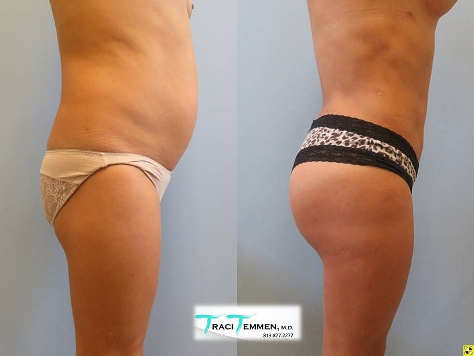 Liposuction Before & After